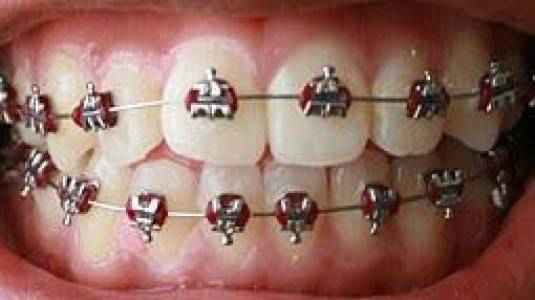 Orthodontics Treatment(Braces)