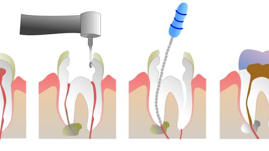 Root Canal Treatment(RCT)