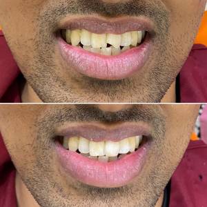 Fillings & Restorative dentistry