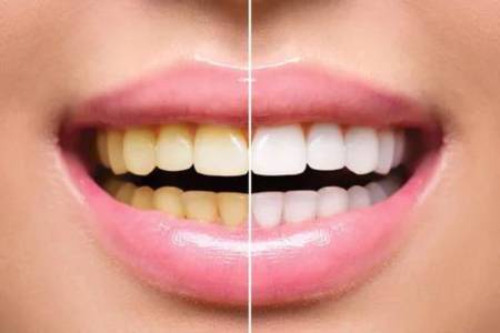 Teeth Whitening
