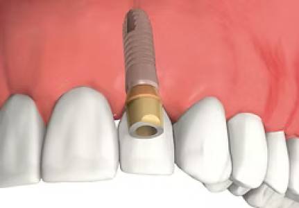 dental implants