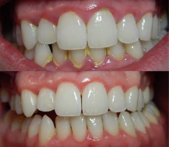 Gingivitis Treatment