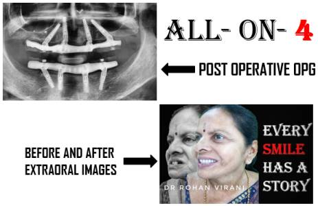 All On X Dental Implants