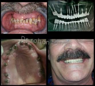 Swiss Dental Implants