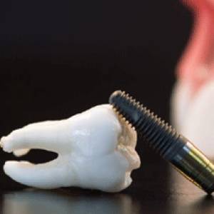 Dental Implant