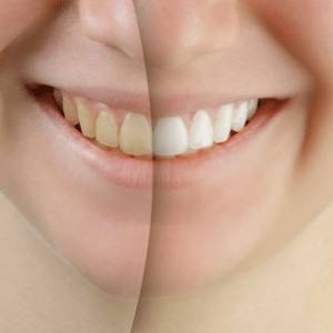 Teeth Whitening