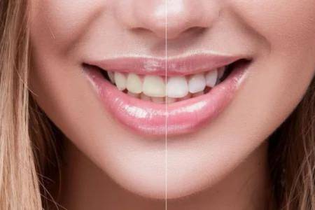 Teeth Whitening & Bleaching Treatment