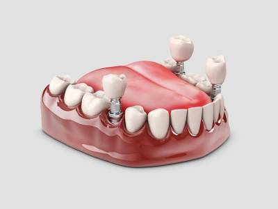 DENTAL IMPLANTS