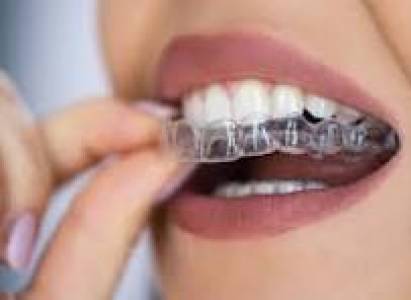aligners