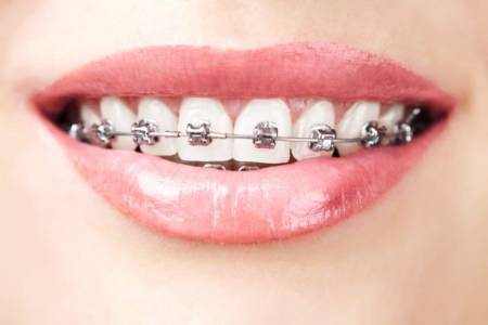 Braces Treatment in Andheri West