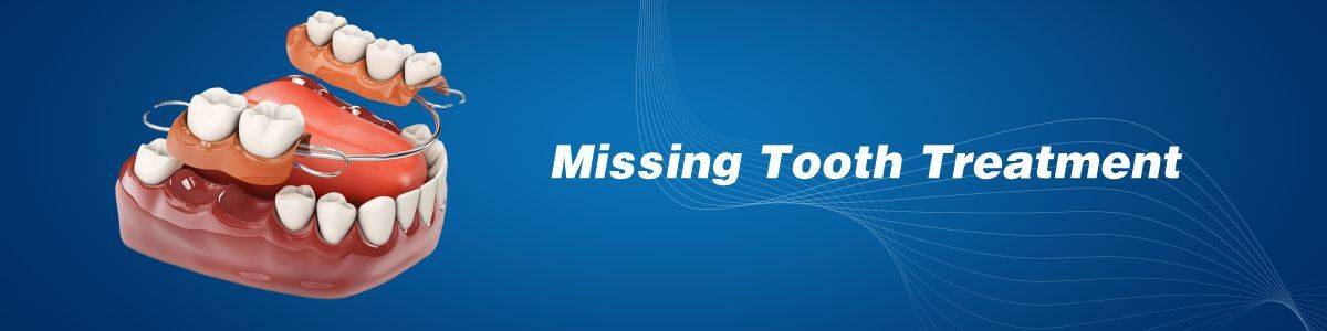 Missing Tooth Treatment