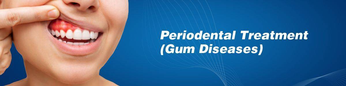 Periodental Treatment (Gum Diseases)
