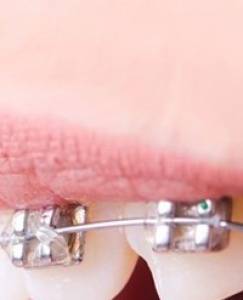 Conventional Metal Braces