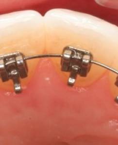 Lingual Braces