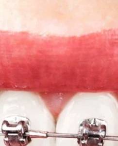 Self ligation Technique