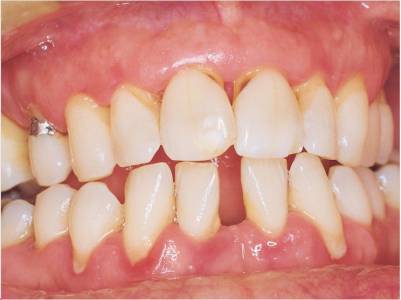 Periodontitis