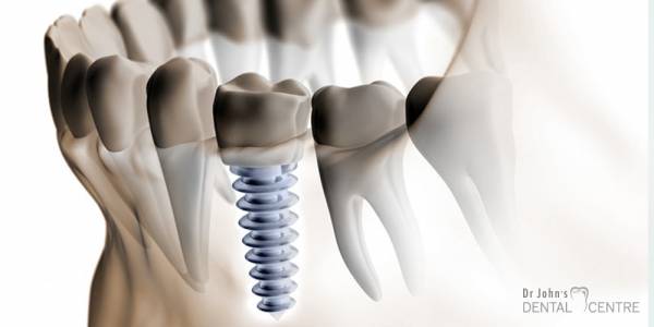 Dental Implants