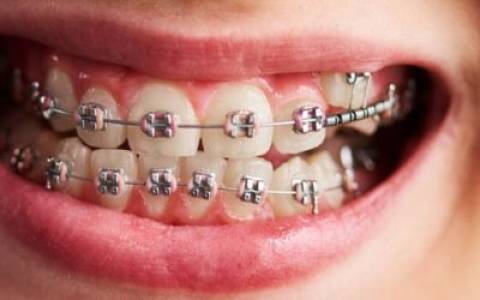 Orthodontic Treatments
