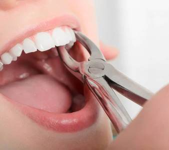 Tooth Extraction (Painless)