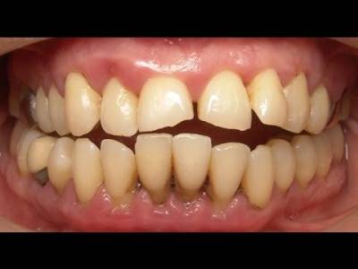 Advance Gum Treatment/Periodontal Surgery