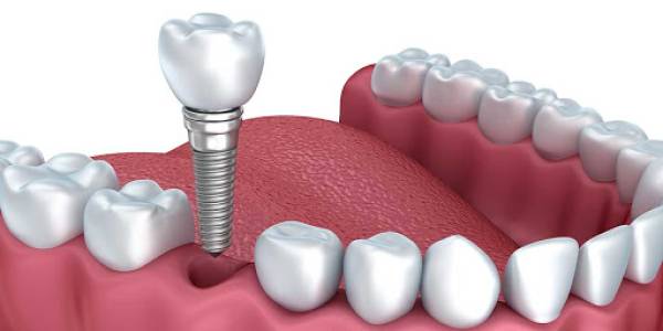 Dental Implant