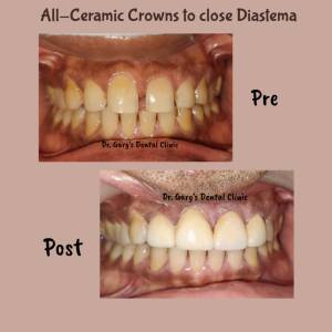 PERIODONTAL/GUM/FLAP SURGERY