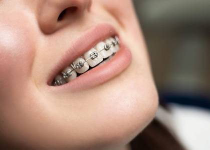 BRACES AND ALIGNERS