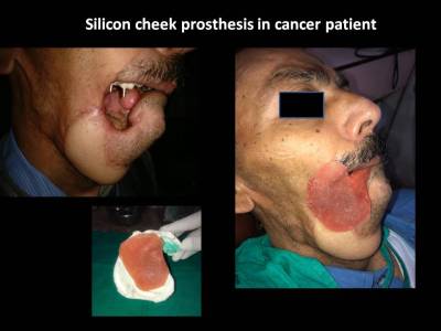 Oral Submucous Fibrosis