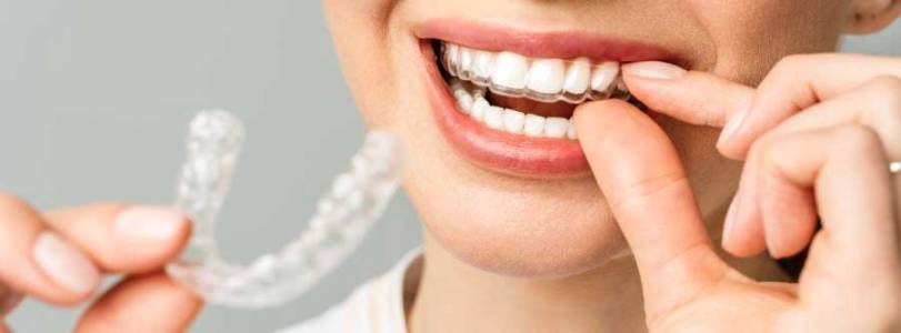 Invisible Braces Indore
