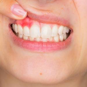 Gingivitis Treatment
