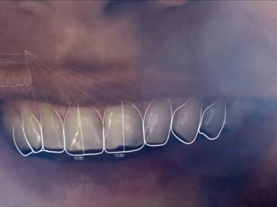 Smile Makeover in Indore