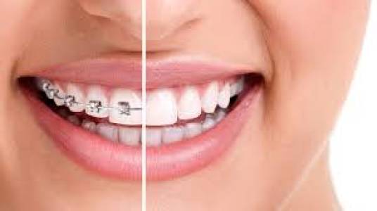 Best Orthodontic in Indore