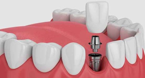 Dental Implants Indore