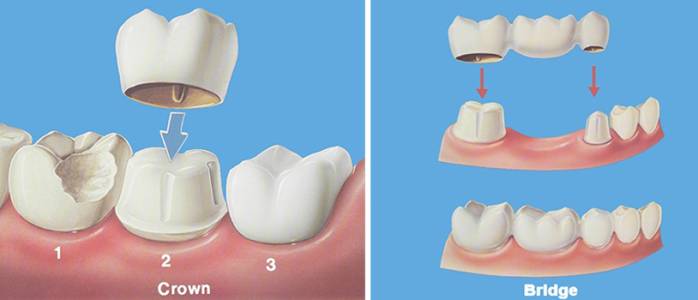 Fillings and cavities treatment