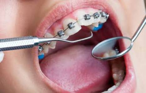 Orthodontic Treatments