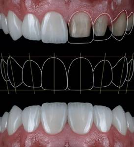 digital smile designing