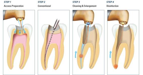 Root Canal Treatment
