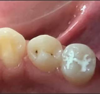 Fissure Sealants