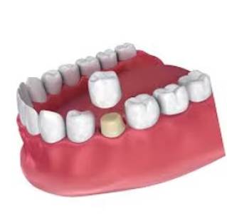 Dental Crown