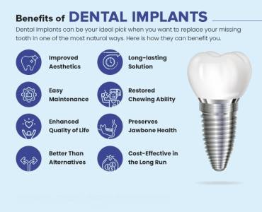 Dental Implants