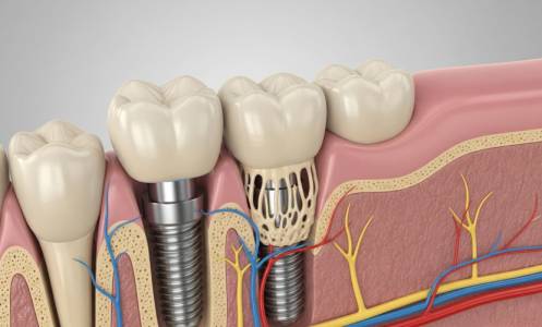 Dental Implants