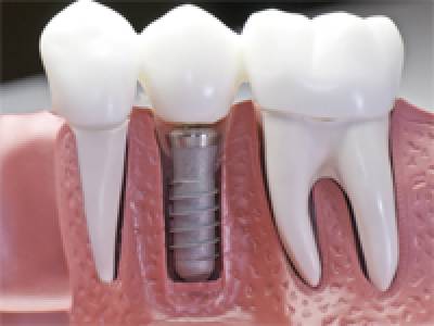 Dental Implants