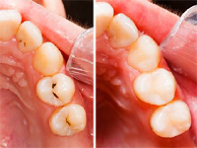 Tooth Coloured Fillings