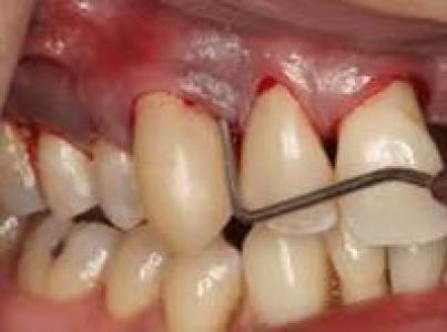 Gum Treatment