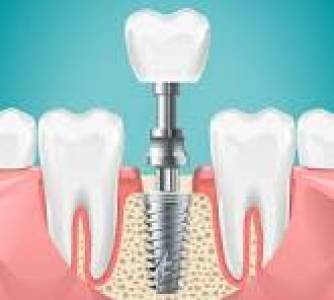 Dental Implants