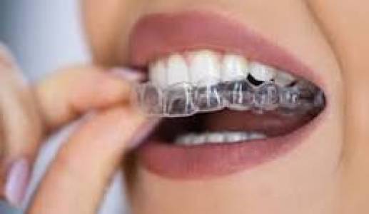 clear aligners