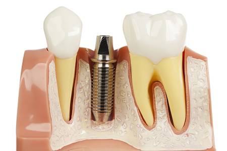 Dental implants