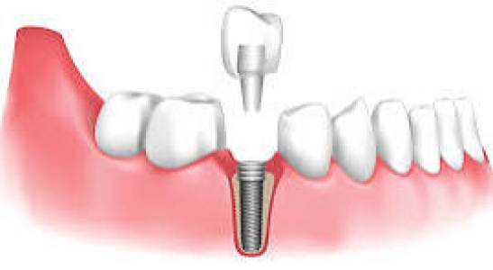 Dental Implants