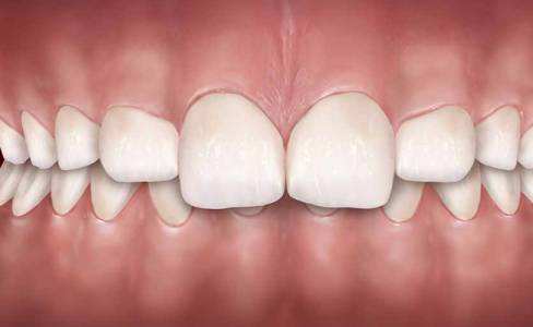 Surgical Corrections