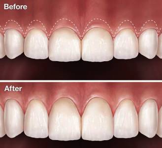 maxillo facial surgery